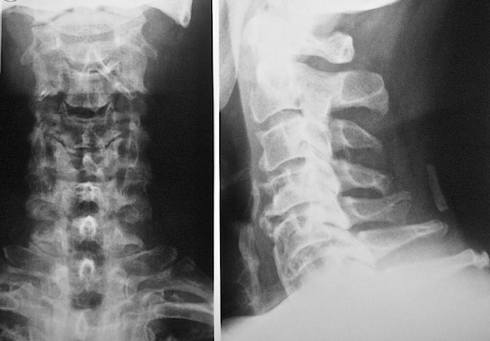 cervical spine x-ray with osteochondrosis