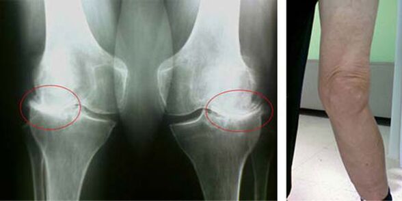 knee osteoarthritis radiography