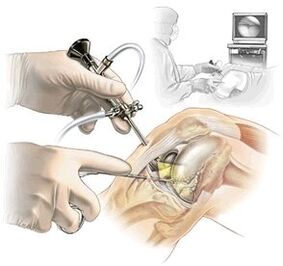 Clarification of the diagnosis of arthrosis of the drug for traces